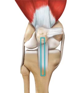 ACL Reconstruction Patellar Tendon