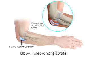 Elbow (Olecranon) Bursiti