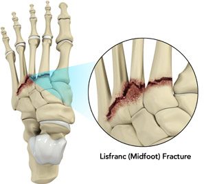 Lisfranc (Midfoot) Fracture