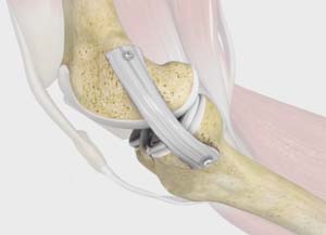 Medial Collateral Ligament Reconstruction Denver, CO | MCL Injury ...