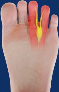 Mortons Neuroma