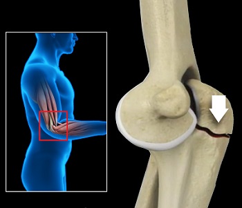 Olecranon (Elbow) Fractures