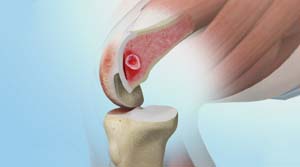 Autologus Chondrocyte Implantation