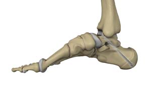 Subtalar Arthroscopy